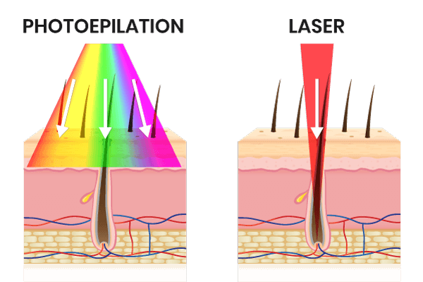 Vergleich zwischen Photoepilation und Laser